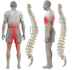 irora pada ni osteochondrosis thoracic