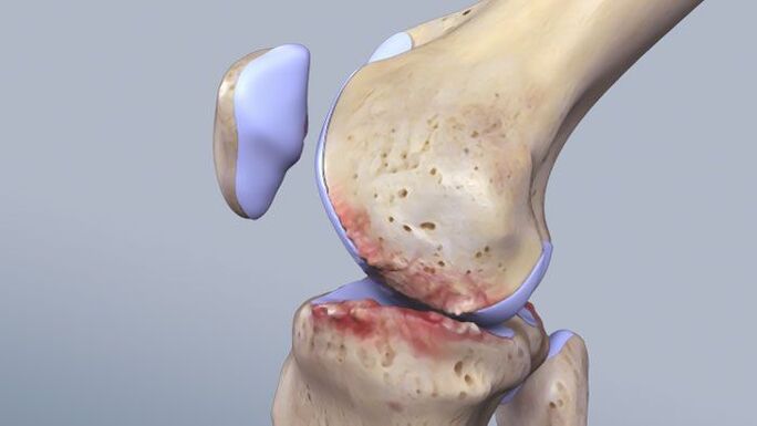 Ilana ti isẹpo orokun ti o ni ipa nipasẹ pathology