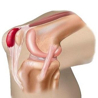 Ọkan ninu awọn okunfa ti irora ni apapọ orokun jẹ bursitis. 