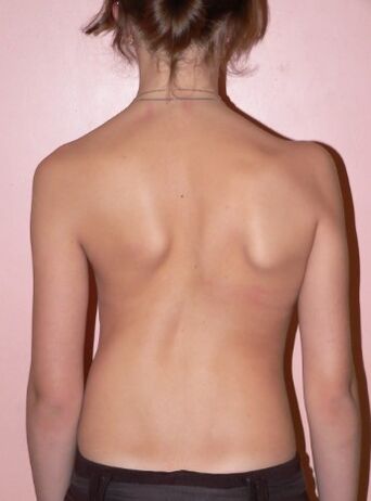 Scoliosis 2 iwọn