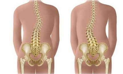 Ti kii ṣe scoliosis