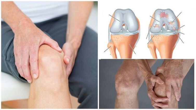 Ami irora ọpọlọ ti arthrosis ti apapọ orokun