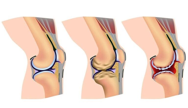 Awọn ipele ti abuku ni apapọ orokun fun arthrosis