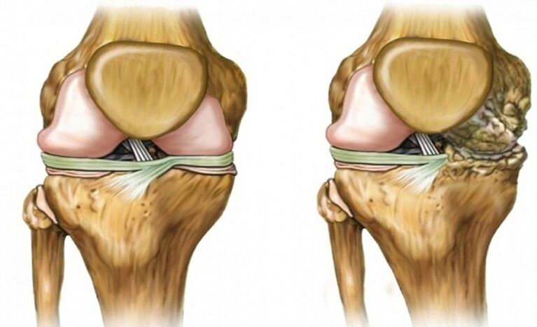 Ni ilera ati fowo nipasẹ apapọ arthrosis