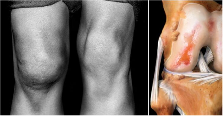 arthrosis ti orokun orokun ati apapọ apapọ