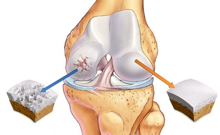 ere-kere deede ati fowo nipasẹ arthrosis