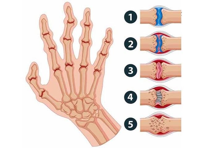 awọn ipele ti idagbasoke arthritis ti awọn isẹpo ika