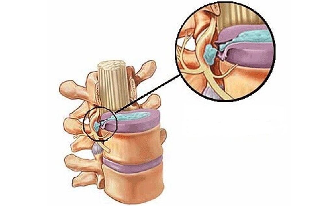 hernia intervertebral pẹlu osteochondrosis thoracic