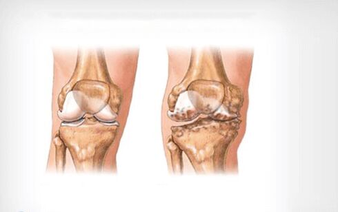 arthrosis ti isẹpo orokun
