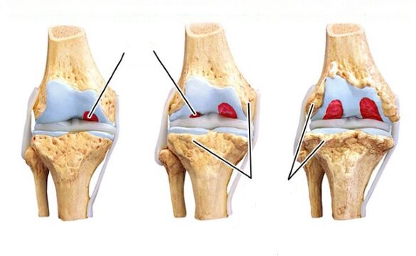 awọn ipele ti arthrosis orokun