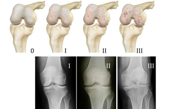 awọn ọna fun ayẹwo arthrosis orokun