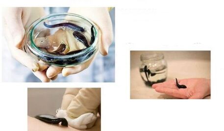 hirudotherapy fun arthrosis